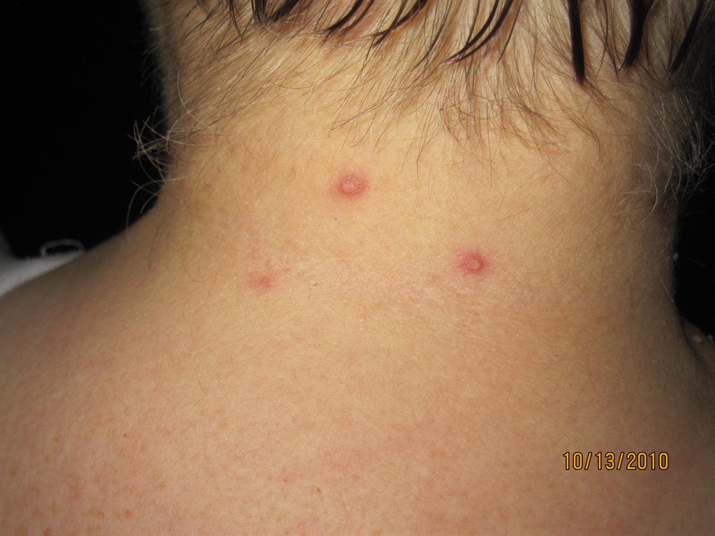 bites similar to bed bug bites | Bedbugs | housenino.com